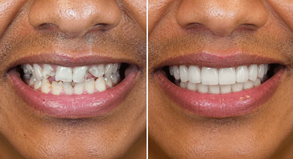 Cosmetic Smile Makeover Result