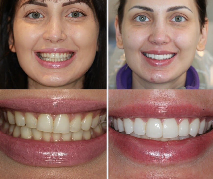 Aesthetic Smile Transformation Result