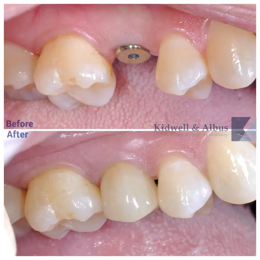 Dental Implant Restoration Result
