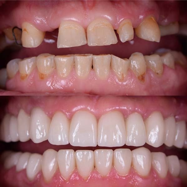 Full Arch Rehabilitation Result