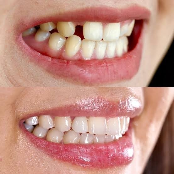 Tooth Alignment and Crown Result